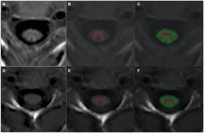 Regional spinal cord volumes and pain profiles in AQP4-IgG + NMOSD and MOGAD